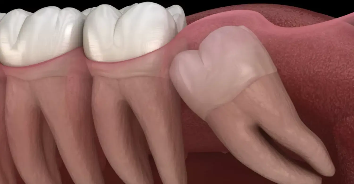 when to stop drinking alcohol before wisdom teeth surgery 2